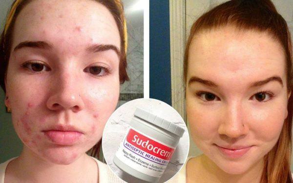 Sudocrem - Not only for baby's diaper rash, but it also has a great effect!