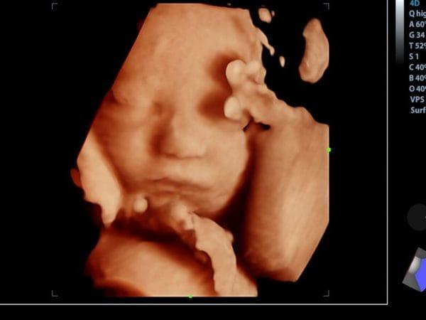 22 주 태아 초음파-태아 상태 확인을위한 중요한 이정표