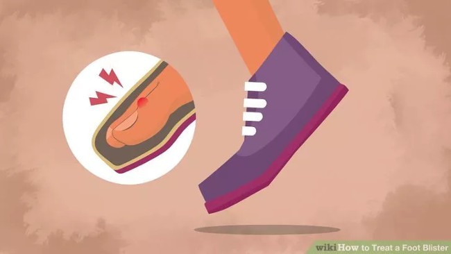 How to treat blisters on feet when walking a lot and wearing tight shoes How to treat blisters on feet when walking a lot and wearing tight shoes